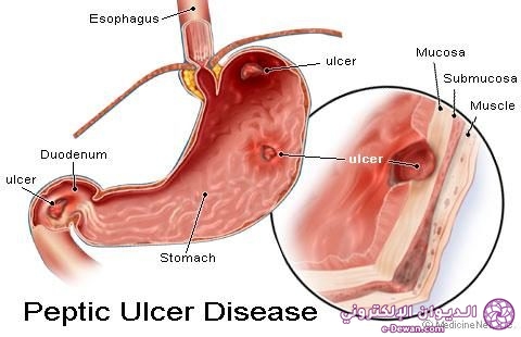 Peptic ulcer 1132x670