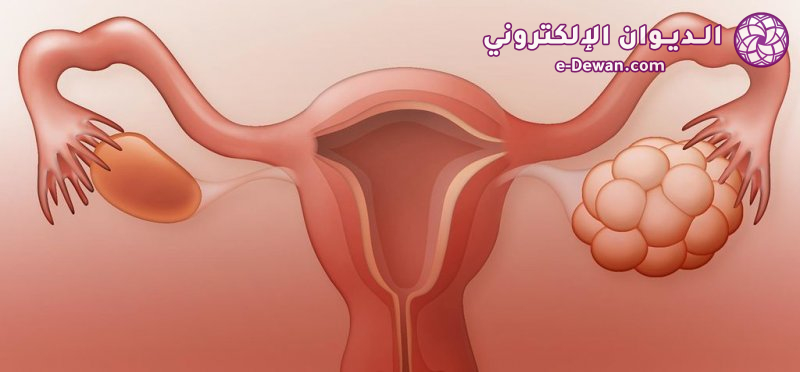 Pcos cysts